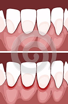 Necrotizing ulcerative gingivitis is a periodontal diseases