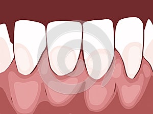 Necrotizing ulcerative gingivitis is a periodontal diseases