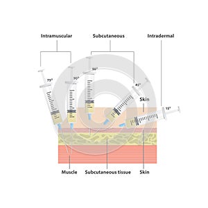 Needle Angles illustration vector on white background. Health