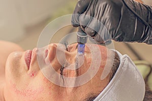 Needle mesotherapy treatment on a woman face.