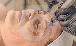 Needle mesotherapy treatment on a woman face. photo