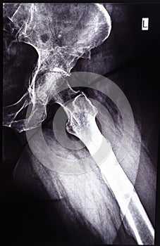 negative x-ray side view of acetabular cavity