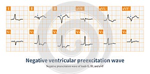 Negative ventricular preexcitation wave photo