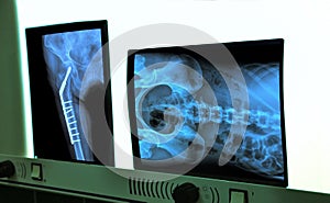 negatoscope with xray of hip and spine