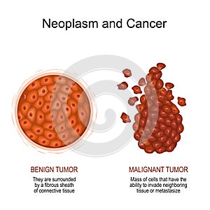 Neoplasm and Cancer. malignant and benign tumor photo
