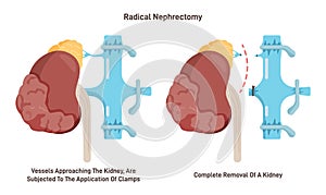 Nephrectomy, surgical removal of a kidney. Diseased swelling kidney