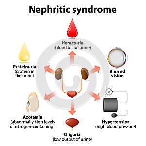 Nephritic syndrome