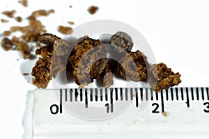 Nephrolithiasis, irregular brown kidney stones (renal calculus or nephrolith), the stones are different in size photo