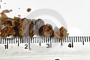 Nephrolithiasis, irregular brown kidney stones (renal calculus or nephrolith), the stones are different in size photo