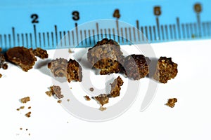 Nephrolithiasis, irregular brown kidney stones (renal calculus or nephrolith), the stones are different in size