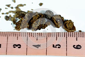 Nephrolithiasis, irregular brown kidney stones (renal calculus or nephrolith), the stones are different in size