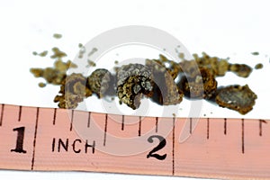 Nephrolithiasis, irregular brown kidney stones (renal calculus or nephrolith), the stones are different in size