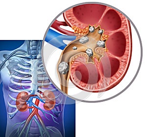 Nephrolithiasis or kidney stone deposits