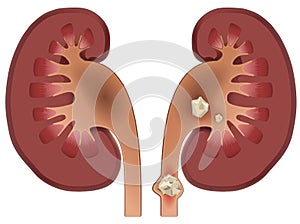 Nephrolithiasis kidney stones disease