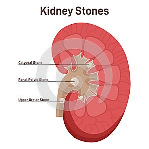 Nephrolithiasis. Kidney stones disease. Nephrology and urology photo