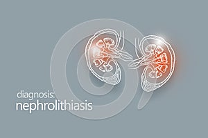 Nephrolithiasis kidney stones disease or urolithiasis. Renal Calculus or Stones blocking the urinary tract.