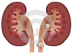 Nephrolithiasis kidney stones disease photo
