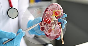 Nephrologist or urologist shows mockup of human kidney