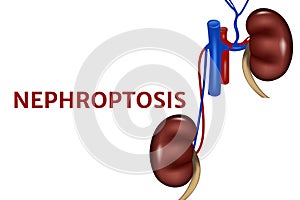 Nephroptosis. Anatomical poster with a drooping kidney.