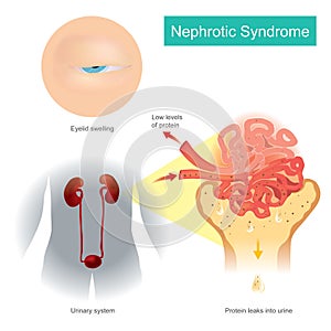 Nephrotic Syndrome. Illustration explain A kidney disorder that causes your body to pass too much protein in your urine