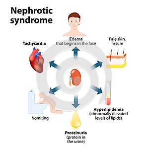 Nephrotic syndrome