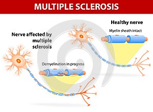 Nerve affected by multiple sclerosis