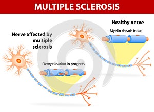 Nerve affected by multiple sclerosis photo