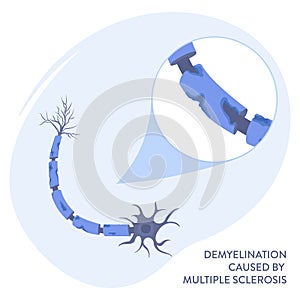 Nerve cell demyelination process medical infographic poster