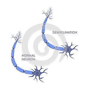 Nerve cell demyelination process medical infographic poster