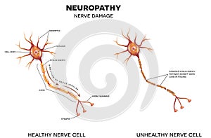 Nerve damage photo