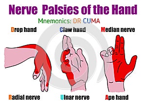 Nerve palsies of the hand. Illustration for students and doctors