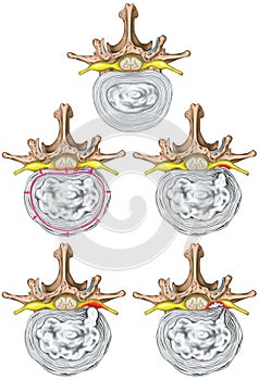 Nerves, stages of lumbar disc herniation photo