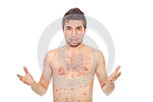 Nervous man with chickenpox