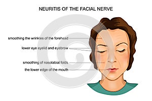 Neuritis of the facial nerve