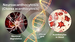 Neuroacanthocytosis, or Chorea acanthocytosis, a neurodegenerative disease, conceptual 3D illustration