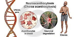 Neuroacanthocytosis, or Chorea acanthocytosis, a neurodegenerative disease, conceptual 3D illustration