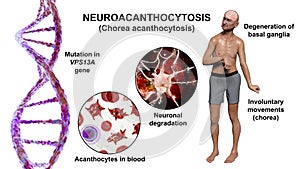 Neuroacanthocytosis, or Chorea acanthocytosis, a neurodegenerative disease, conceptual 3D illustration