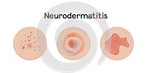 Neurodermatitis examples vector illustration design, allergic problems