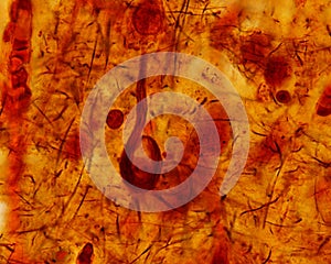 Neurofibrillary tangle. Alzheimer disease