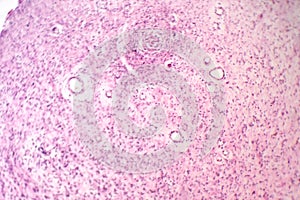 A neurofibroma tissue sample in neurofibromatosis genetic disease, light micrograph