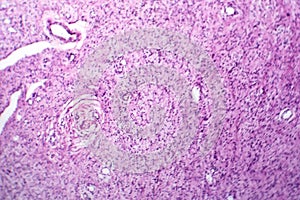 A neurofibroma tissue sample in neurofibromatosis genetic disease, light micrograph