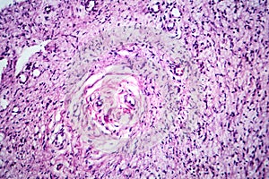 A neurofibroma tissue sample in neurofibromatosis genetic disease, light micrograph