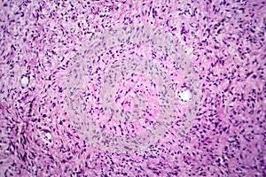 A neurofibroma tissue sample in neurofibromatosis genetic disease, light micrograph