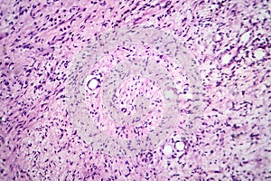 A neurofibroma tissue sample in neurofibromatosis genetic disease, light micrograph