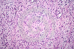 A neurofibroma tissue sample in neurofibromatosis genetic disease, light micrograph