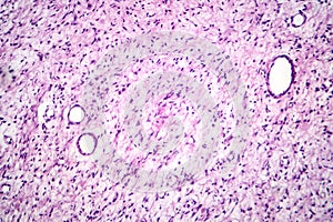 A neurofibroma tissue sample in neurofibromatosis genetic disease, light micrograph