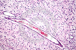 A neurofibroma tissue sample in neurofibromatosis genetic disease, light micrograph