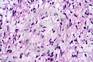 A neurofibroma tissue sample in neurofibromatosis genetic disease, light micrograph