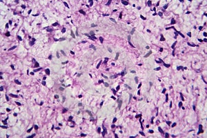 A neurofibroma tissue sample in neurofibromatosis genetic disease, light micrograph