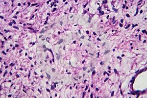 A neurofibroma tissue sample in neurofibromatosis genetic disease, light micrograph